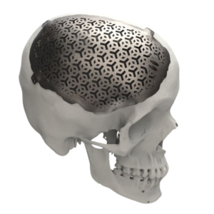 IMPLANTES A LA MEDIDA