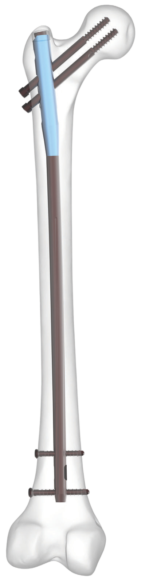 CLAVO ANTEROGRADO DE FEMUR