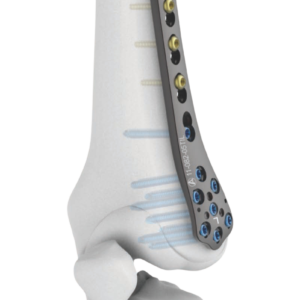 PLACA DE FEMUR DISTAL