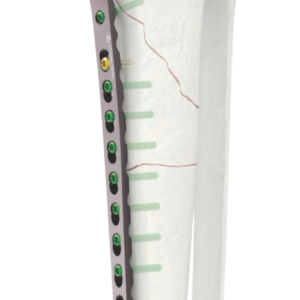 PLACAS DE TIBIA PROXIMAL