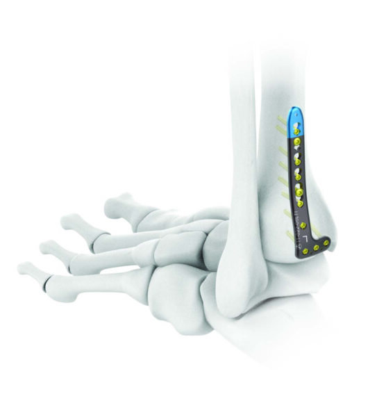 PLACAS TIBIA DISTAL - Image 2